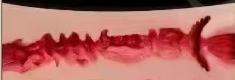 Vagina type 1